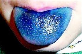 혓바늘 없애는 방법