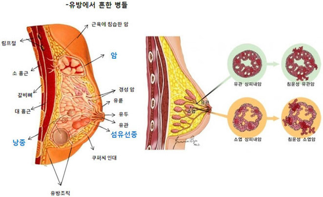 유방 섬유선종 수술, 절제과정, 관리법및 필요성, 중요성