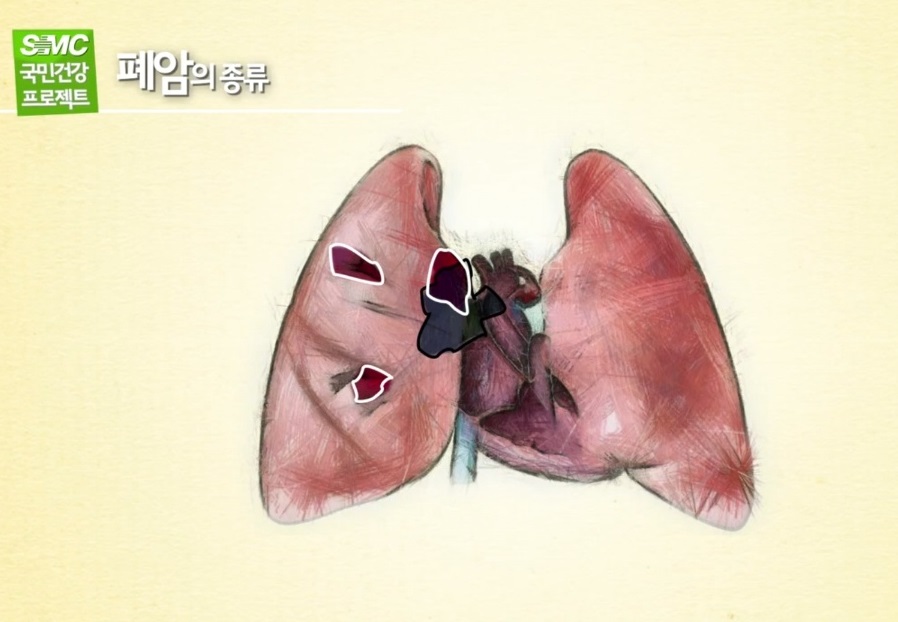 폐암종류