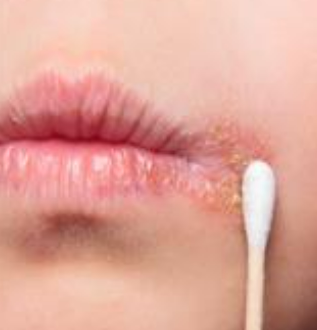 입술 포진(구순포진)