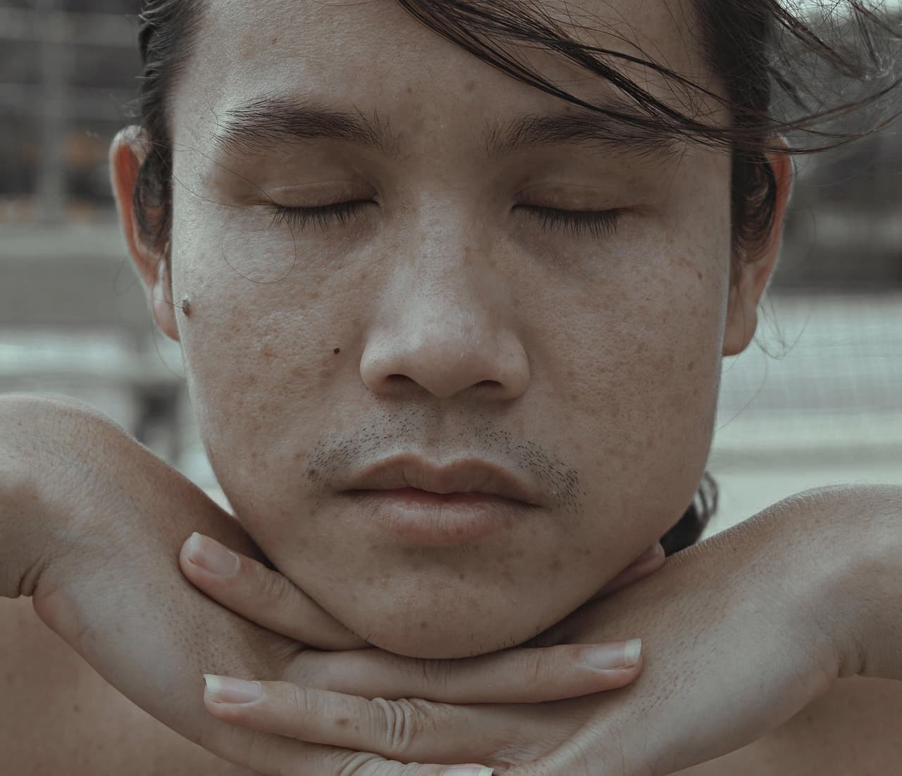 모공 확장(Enlarged pores)