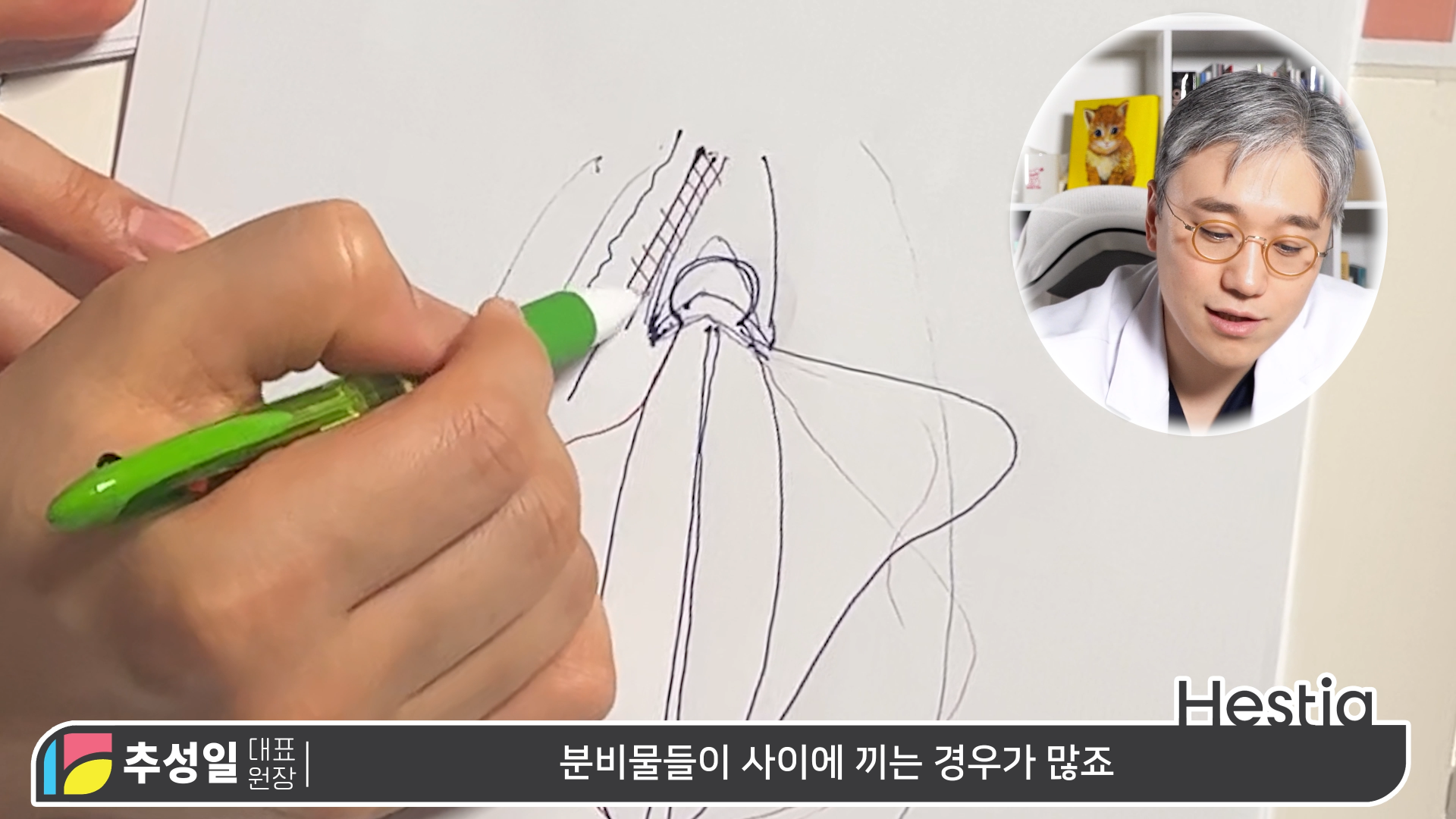 소음순변형은 '이런' 경우가 있습니다.