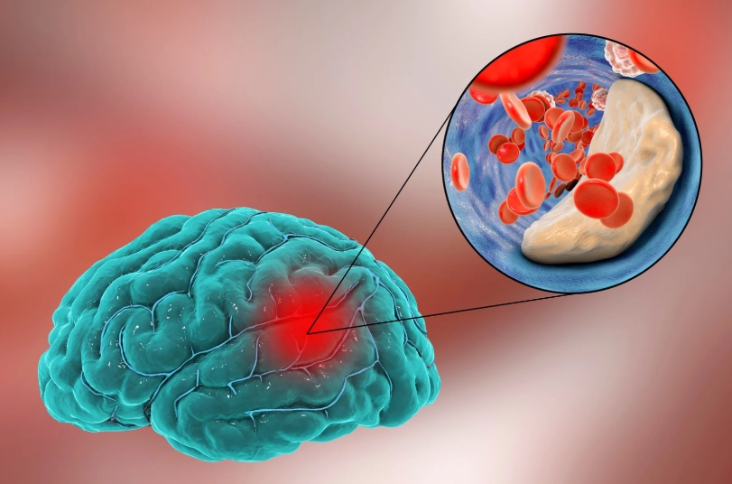 의사가 말하는 뇌출혈 전조 증상