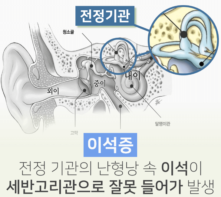 이석증 자가치료법
