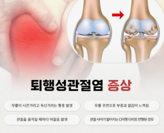 퇴행성관절염 증상 이미지