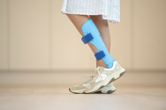 급성구획증후군 정형외과 응급 진단 치료