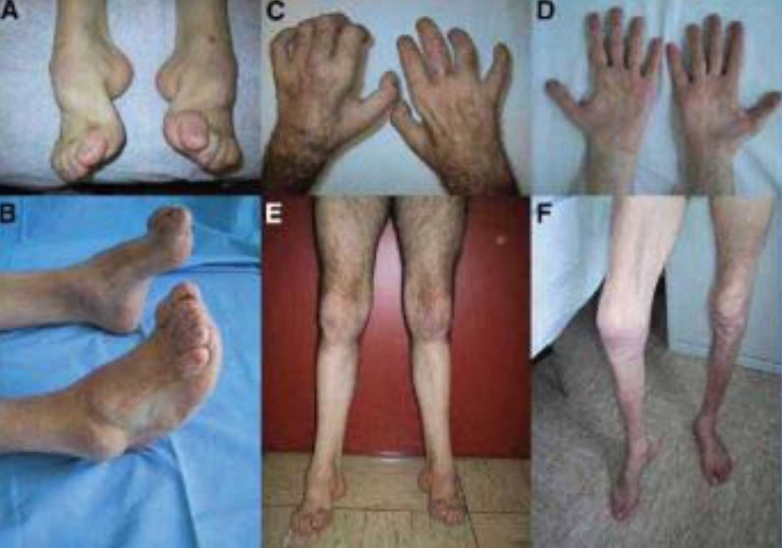 삼성가 이부진 사장 걸음걸이와 샤르코 마리 투스 유전병 팩트체크