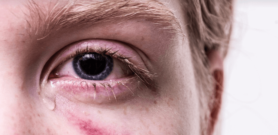 눈이 아픈 사람의 눈동자 사진 - 3