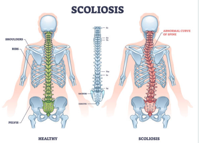 척추 측만증과 관련된 사진