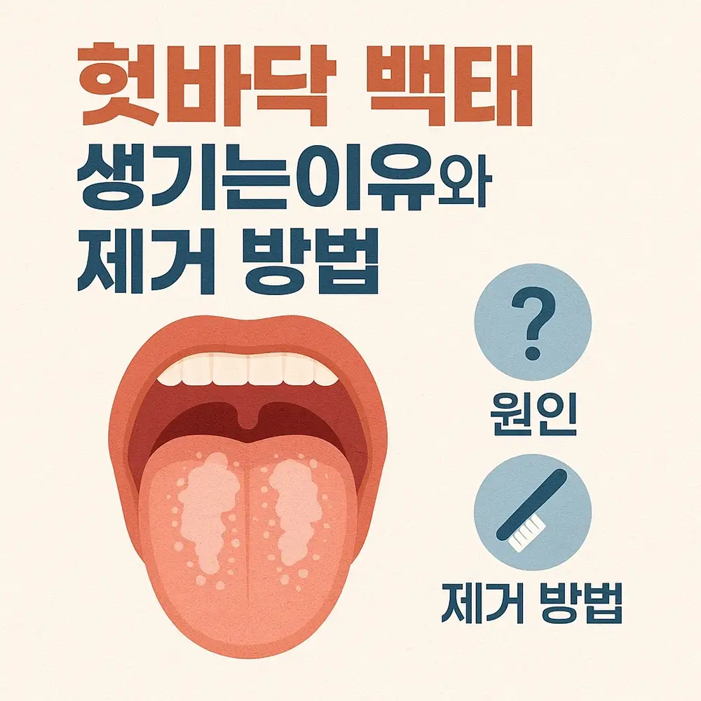 혓바닥 백태 생기는이유와 제거 방법