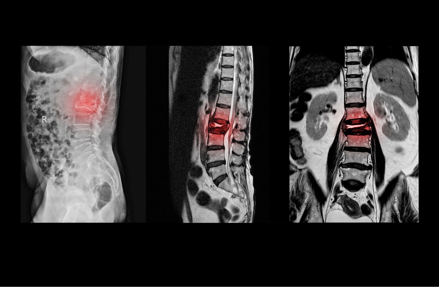 척추관 협착증 증상