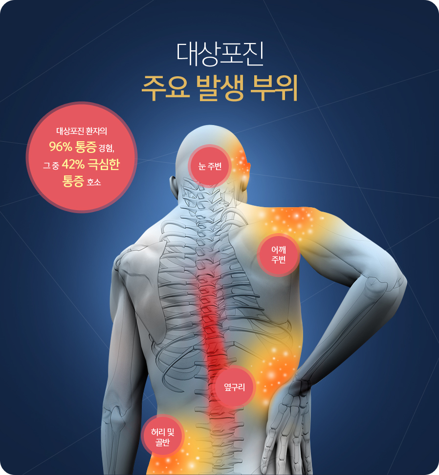 대상포진