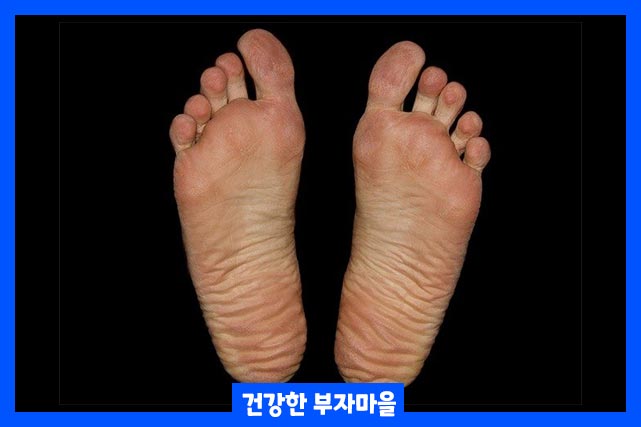 족저근막염 원인