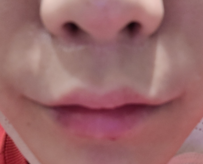 인중 축소 수술 후기