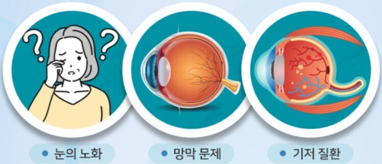 유리체 현상 설명하는 사진