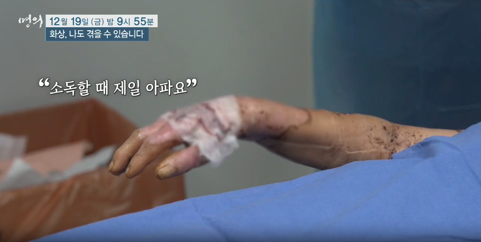 명의 화상 나도 겪을 수 있다