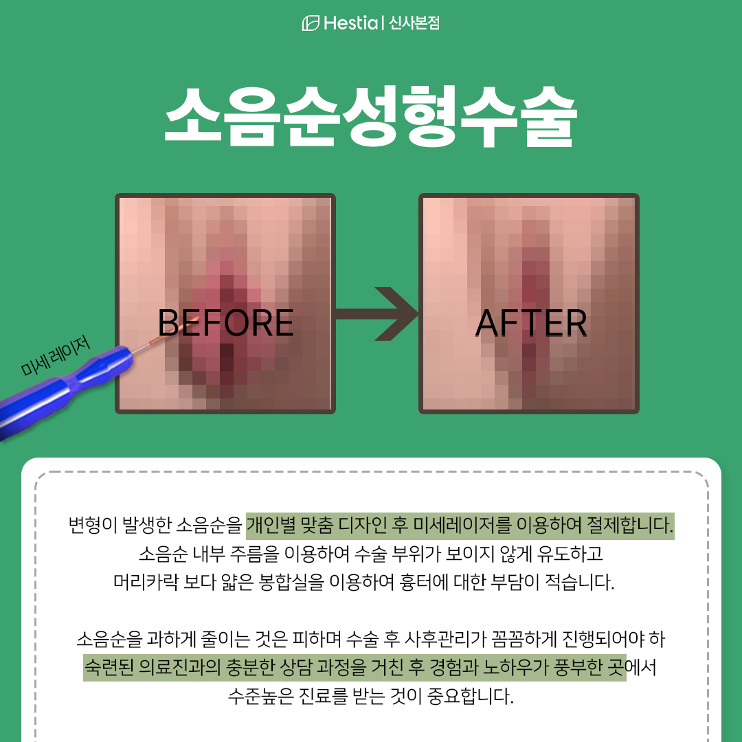 소음순성형수술이란?