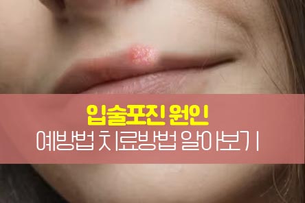 입술포진원인-썸네일