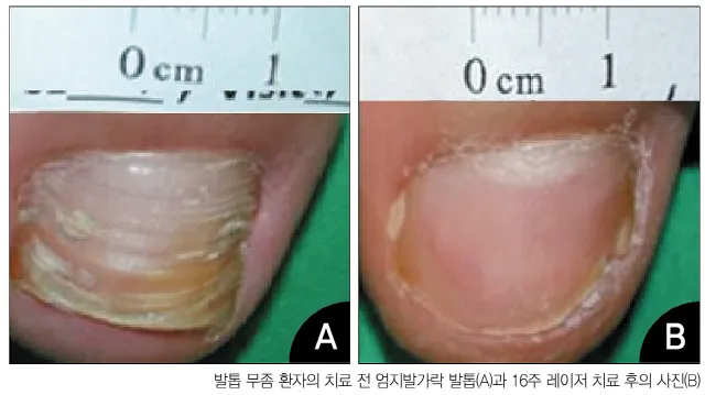 발톱무좀 없애는 방법