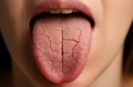 혓바닥이 갈라지는 이유