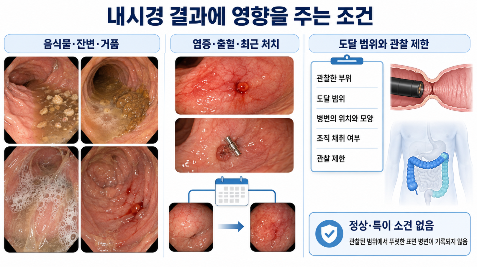 음식물&middot;잔변&middot;거품과 염증&middot;최근 처치&middot;도달 제한이 내시경 결과에 미치는 영향