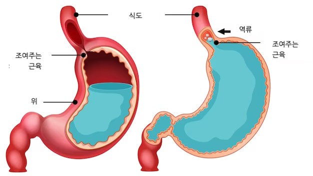 역류성 식도염