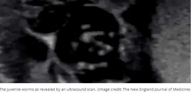 임파선염...음낭 안에서 춤추는 벌레들 VIDEO: Doctors film microscopic worms dancing inside man's scrotum