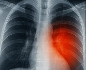 기침이 오래가면 의심되는 질병
