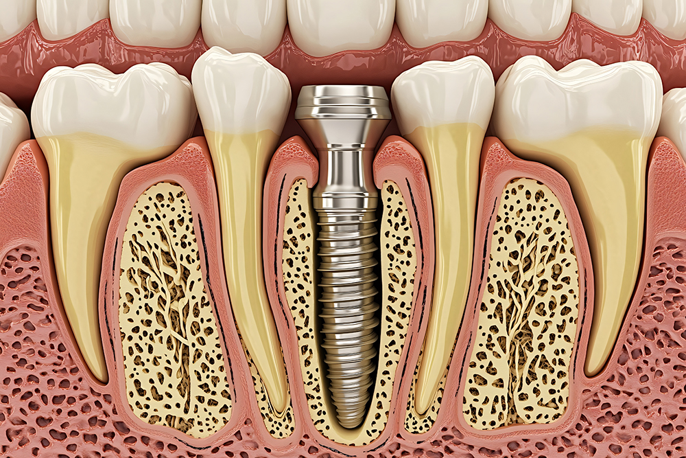 임플란트 시술과정