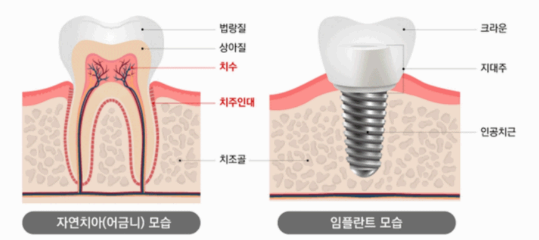 임플란트 사진