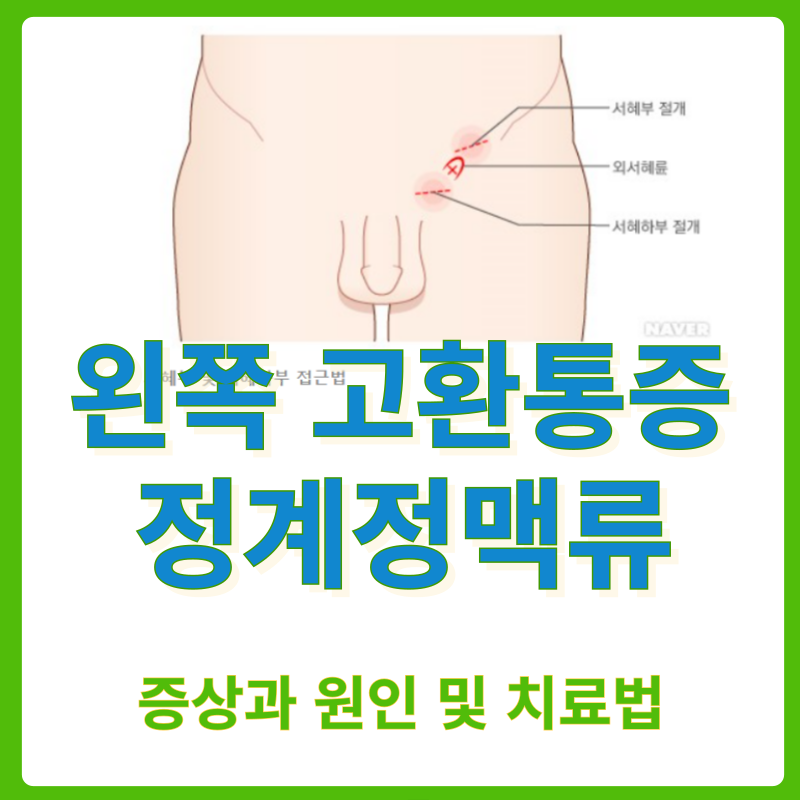 정계정맥류