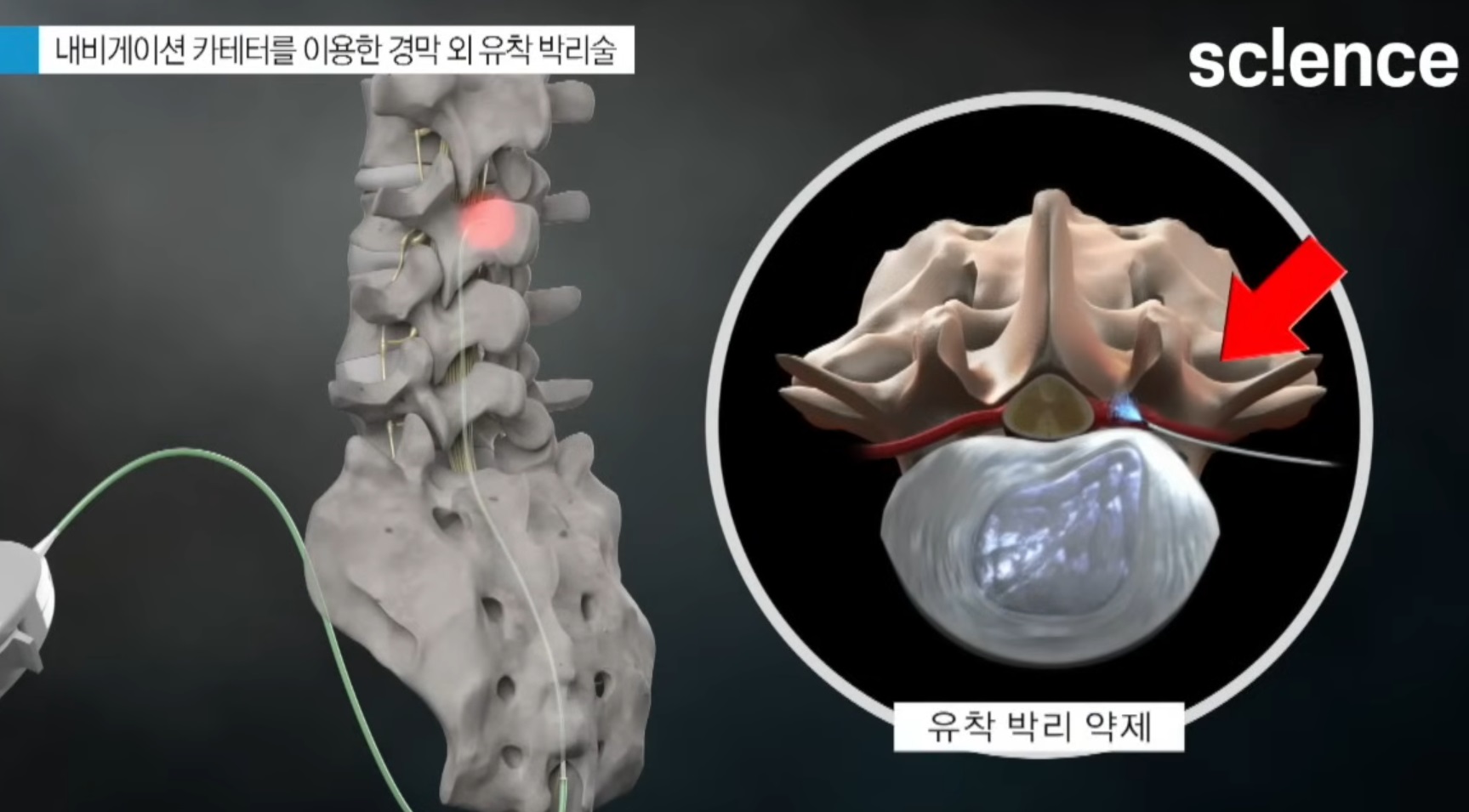 허리디스크-진동규-교수