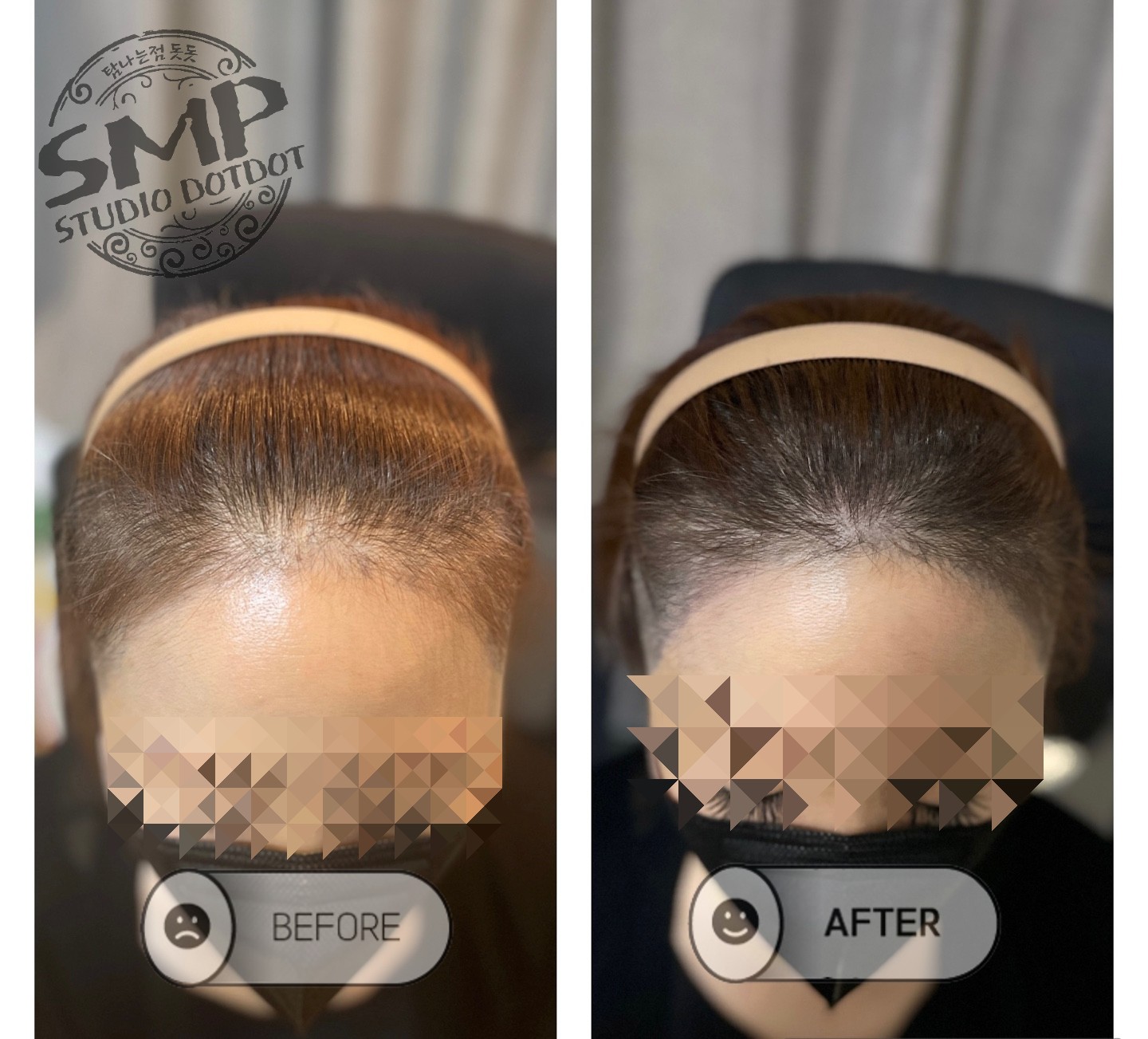 헤어라인-두피문신-후기