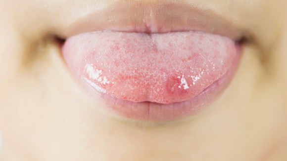 혓바늘이 돋는 이유 원인과 혓바늘 없애는 방법 꿀 치료법 자주돋는 현상 