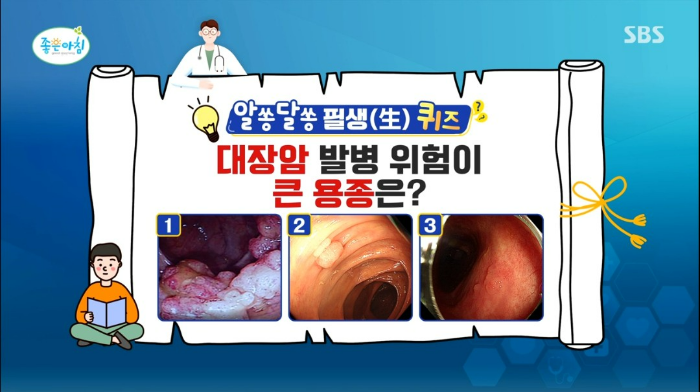 대장암 전단계 용종 종류 제거 재발 대장 내시경