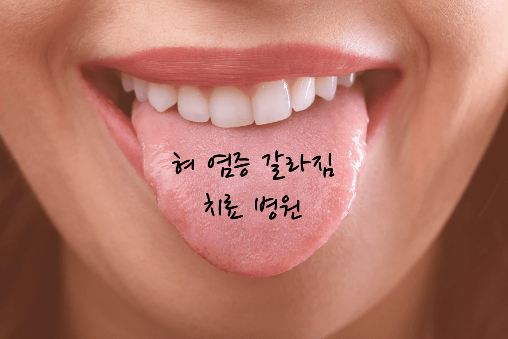 혀 염증