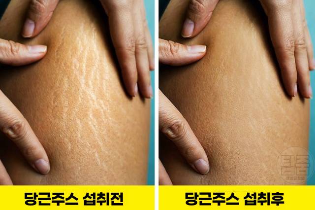 당근주스 효능 튼살 제거 셀룰라이트