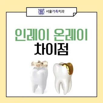 인레이 온레이의 차이와 치료 방법_15
