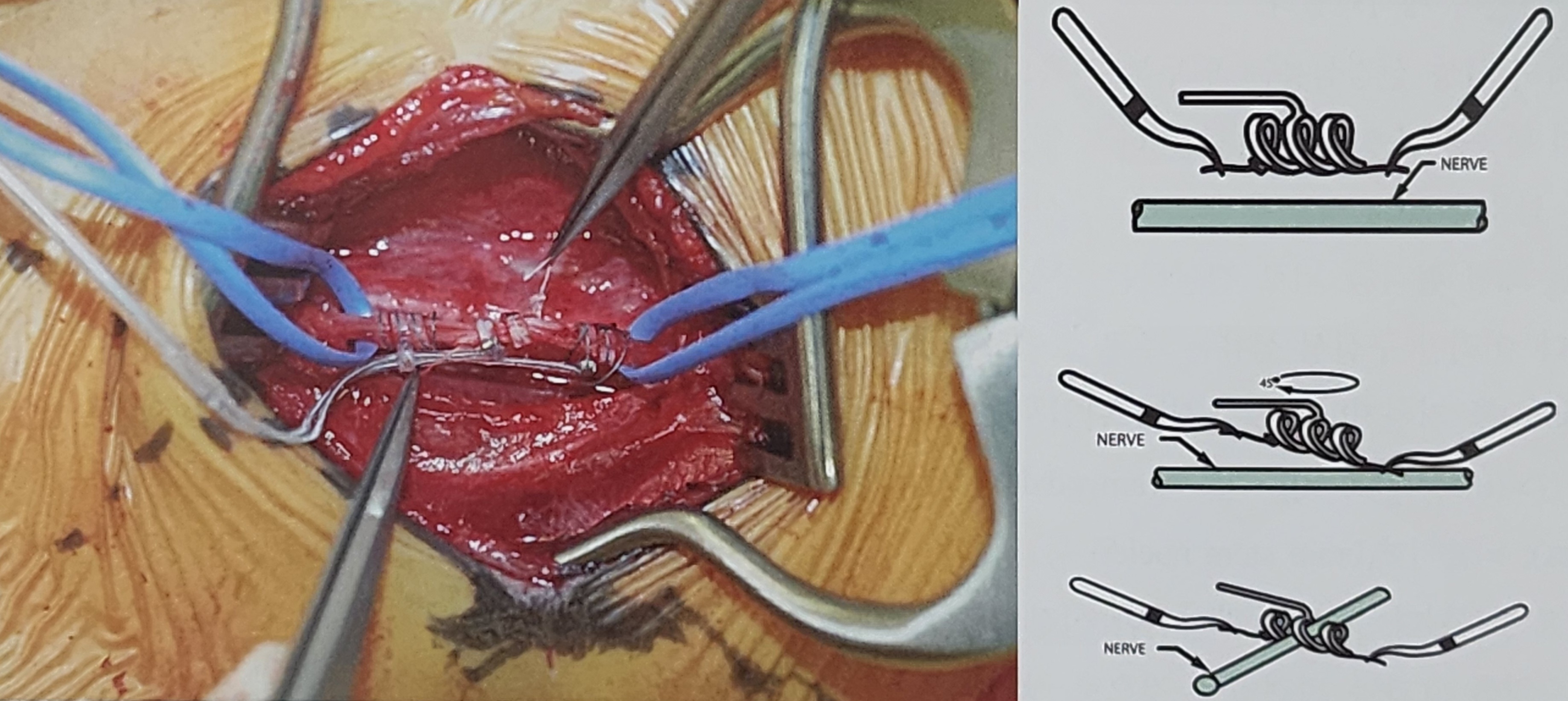 미주신경자극술 및 기타 신경 자극술