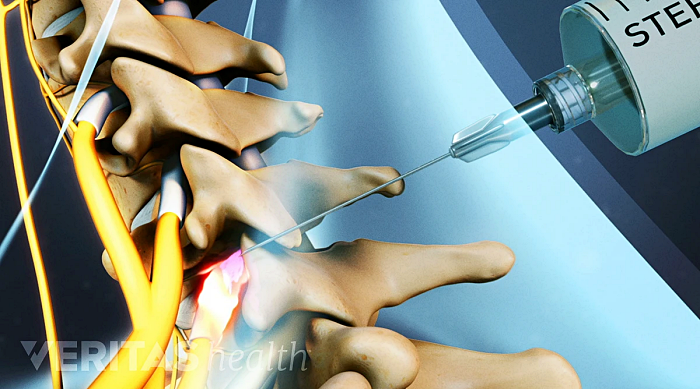 척추 통증 관리의 최전선 - 허리 신경차단술의 비용과 효과