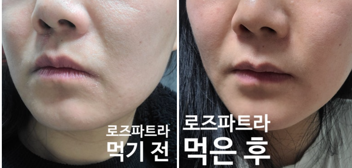 로즈파트라 내돈내산 후기 효과