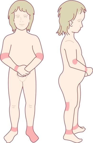 소아기 아토피 증상 사진