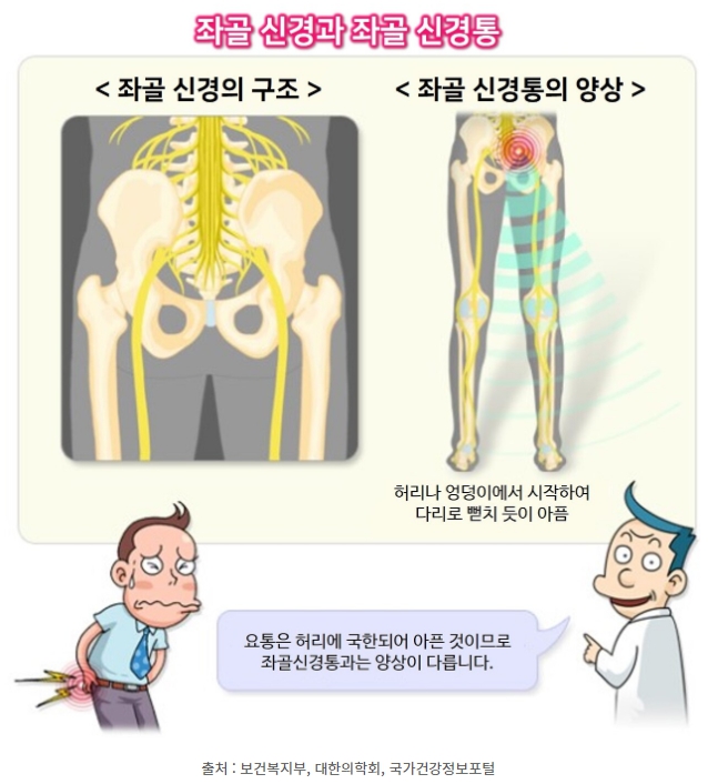 좌골신경 및 좌골신경통을 쉽게 이해할 수 있도록 표현한 이미지로, 좌골신경통이 요통과는 다르게 허리뿐만 아니라 엉덩이에서 다리 전체까지 통증을 수반한다고 표현되고 있습니다.