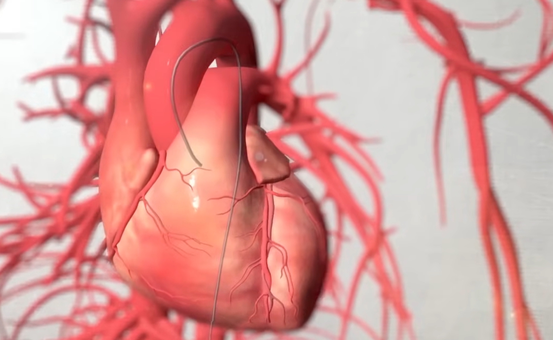 관상동맥 조영술