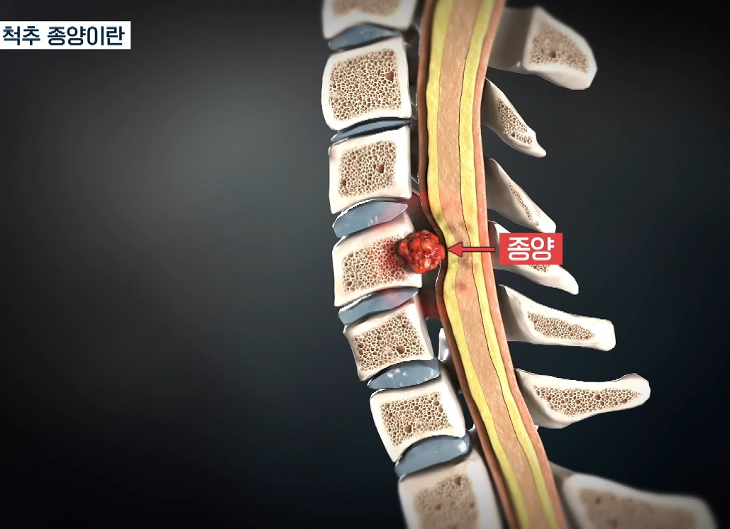 생로병사의-비밀-앉으나서나-척추건강