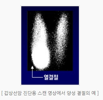 갑상선암 진단