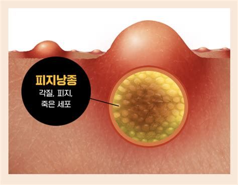 표피낭종 수술