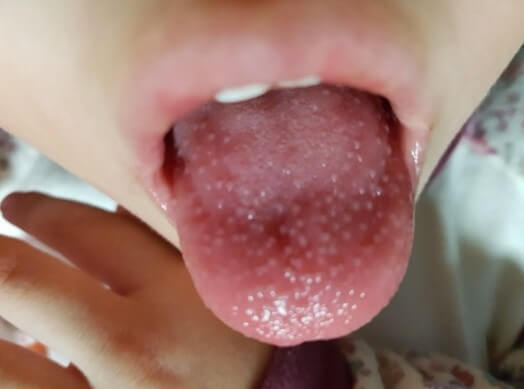 성홍열로 인한 딸기혀 증상