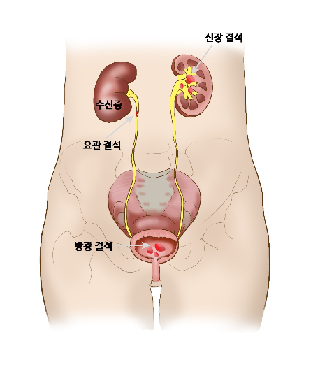 요로결석