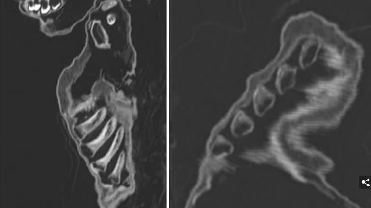 17세기 백작 아들로 밝혀진 미이라 Unravelling the mystery of Austria's mummified TODDLER